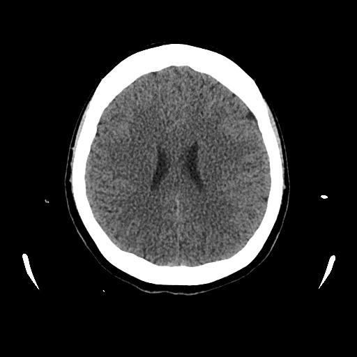 Cerebral venous thrombosis with venous hemorrhagic infarct (Radiopaedia 90354-107660 Axial non-contrast 33).jpg