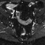 Cervical adenocarcinoma (Radiopaedia 65011-73985 Axial DWI 61).jpg