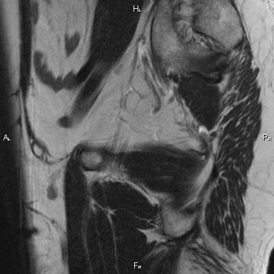 File:Cervical adenocarcinoma (Radiopaedia 65011-73985 Sagittal T2 27).jpg