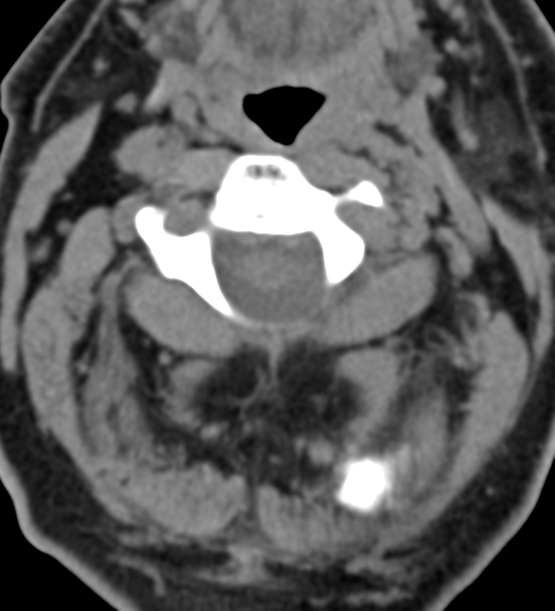 File:Cervical canal stenosis due to ossification of the posterior longitudinal ligament (Radiopaedia 47260-51823 Axial non-contrast 19).png