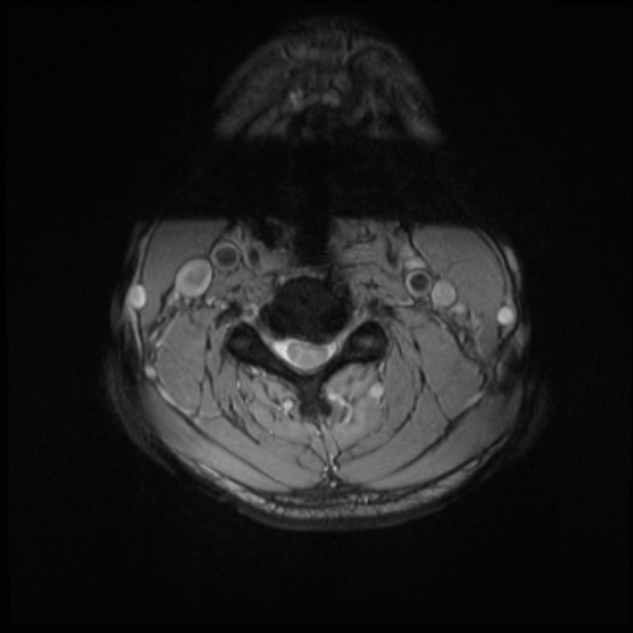 File:Cervical disc extrusion (Radiopaedia 53950-60077 Axial T2 15).jpg