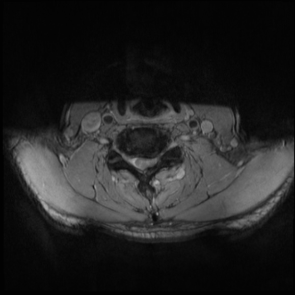 File:Cervical disc extrusion (Radiopaedia 53950-60077 Axial T2 20).jpg