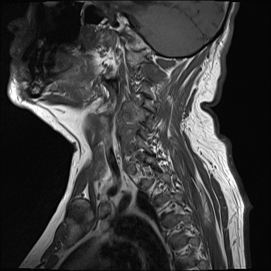 File:Cervical spinal neurofibroma in a patient with NF1 (Radiopaedia 58344-65465 Sagittal T1 11).jpg