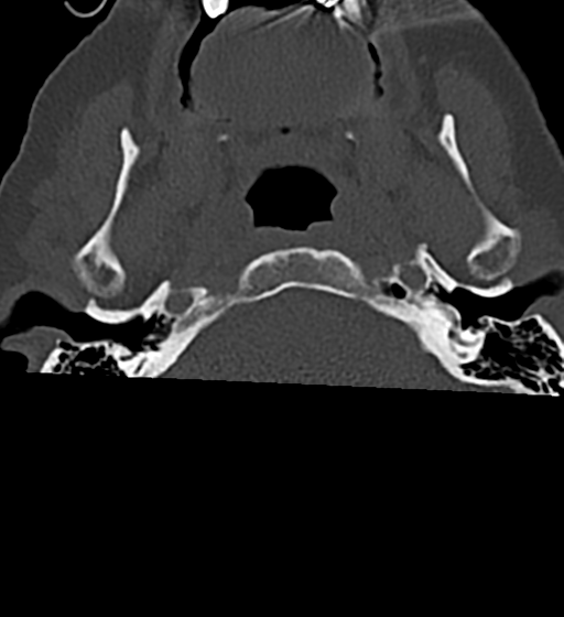 Cervical spine ACDF loosening (Radiopaedia 48998-54070 Axial bone window 4).png