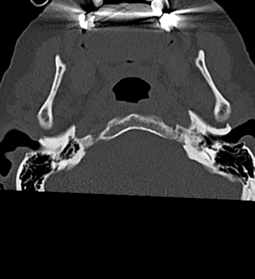 Cervical spine ACDF loosening (Radiopaedia 48998-54070 Axial bone window 5).png