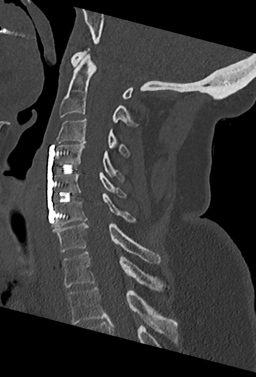 Cervical spine ACDF loosening (Radiopaedia 48998-54070 Sagittal bone window 46).png