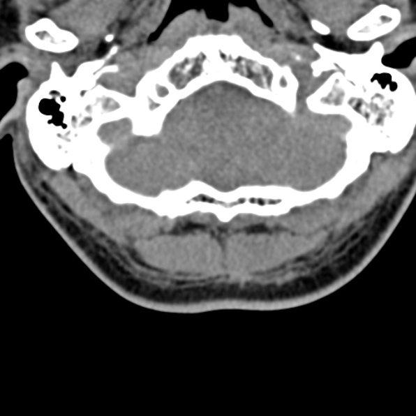 Cervical spondylodiscitis (Radiopaedia 28057-29489 Axial non-contrast 9).jpg