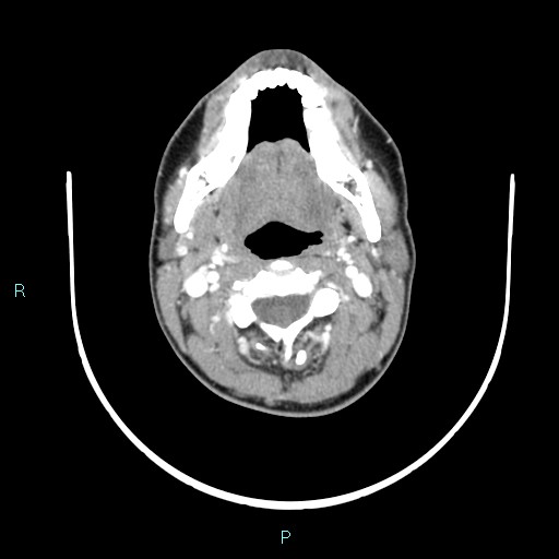 Cervical thymic cyst (Radiopaedia 88632-105335 B 80).jpg
