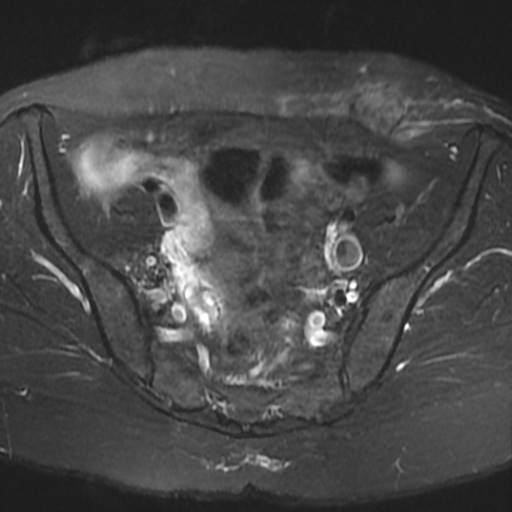 File:Cesarian section scar endometriosis (Radiopaedia 66520-75799 Axial T2 fat sat 7).jpg