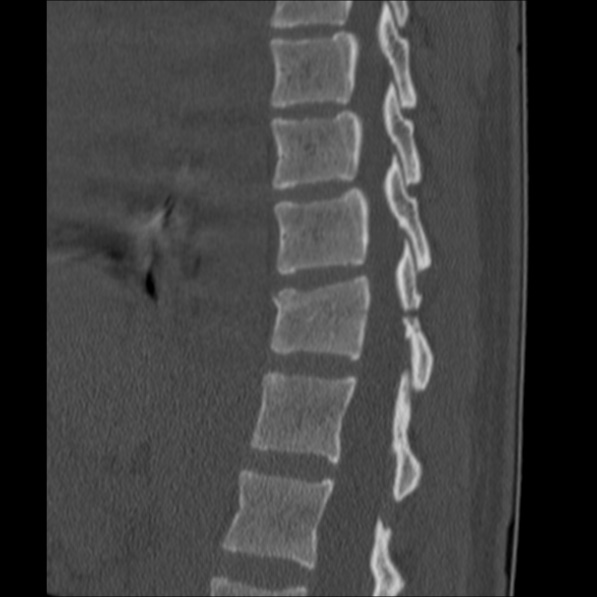Chance fracture (Radiopaedia 36521-38081 Sagittal bone window 41).jpg