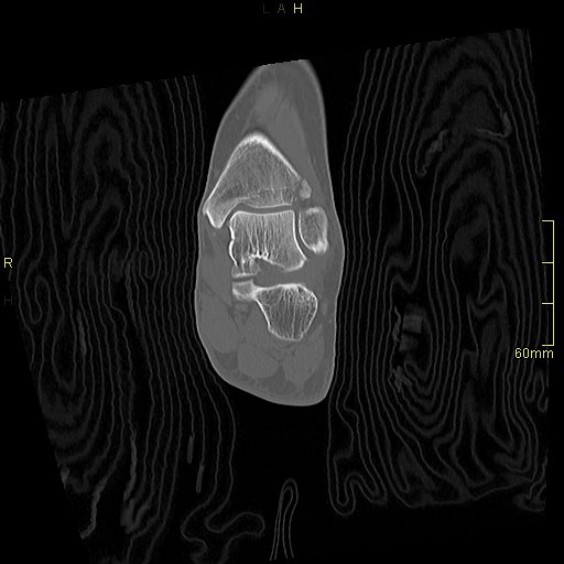 Chaput tubercle fracture (Radiopaedia 80319-93956 Coronal non-contrast 36).jpg