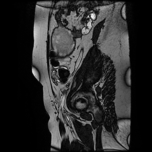 Chiari II malformation - fetal MRI (Radiopaedia 68099-77581 Sagittal Fiesta 47).jpg