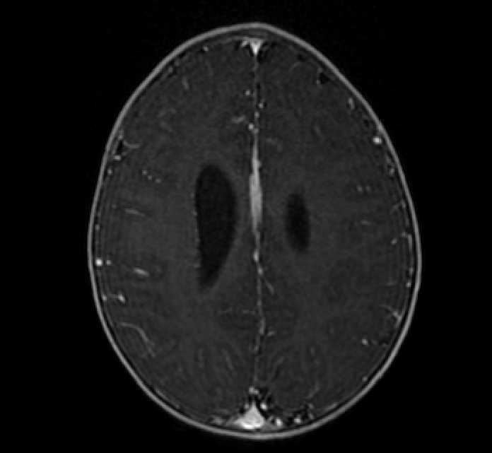 Chiasmatic-hypothalamic glioma (Radiopaedia 90079-107252 Axial T1 C+ 63).jpg