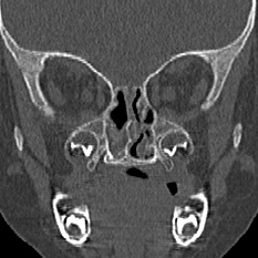 Choanal atresia (Radiopaedia 88525-105975 Coronal bone window 56).jpg