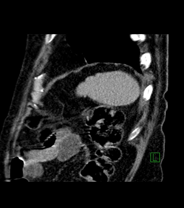 Cholangiocarcinoma with cerebral metastases (Radiopaedia 83519-98629 Sagittal C+ delayed 17).jpg