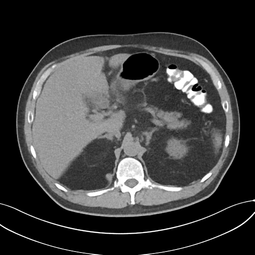 File:Cholecystitis with focal perforation and hepatic abscess (Radiopaedia 37189-38945 Axial non-contrast 23).png