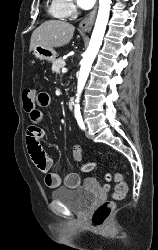 Cholecystoduodenal fistula due to calculous cholecystitis with gallstone migration (Radiopaedia 86875-103077 C 30).jpg