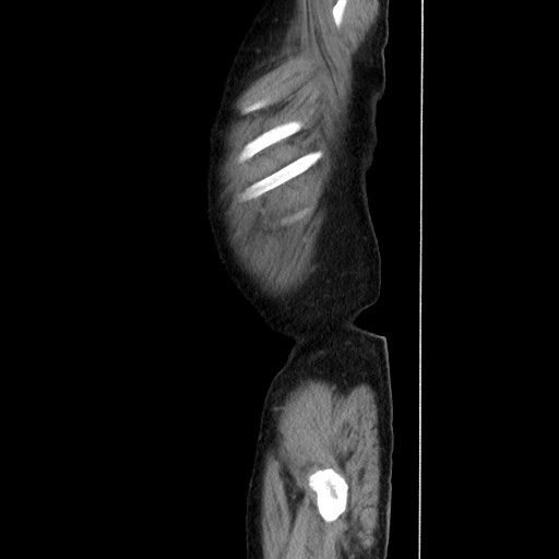 Choledocholiathiasis with normal caliber common bile duct (Radiopaedia 75368-86632 D 20).jpg
