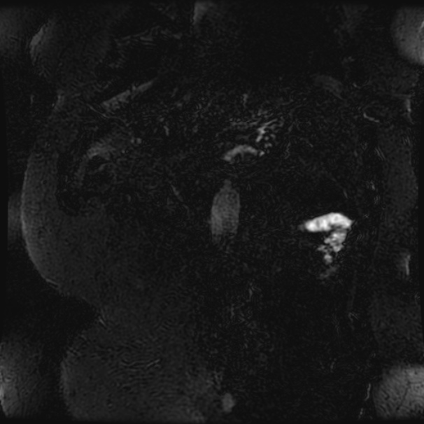 Choledocholithiasis on CT and MRI (Radiopaedia 24825-25088 Coronal T2 107).jpg