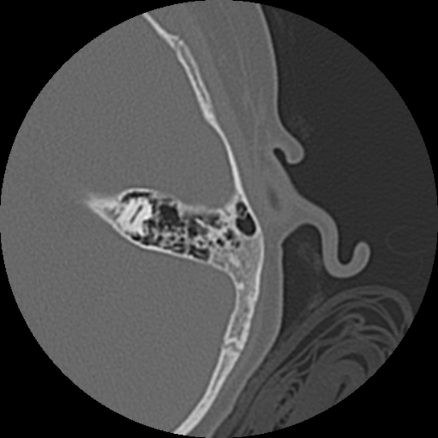 Cholesteatoma (Radiopaedia 73023-83750 Axial Left ear 66).jpg
