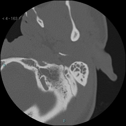 Cholesterol granuloma of the petrous apex (Radiopaedia 64358-73141 Axial bone window 79).jpg