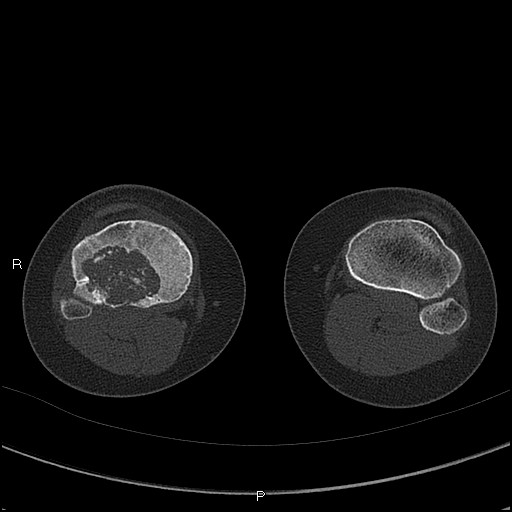 Chondroblastoma (Radiopaedia 62721-71030 Axial bone window 63).jpg