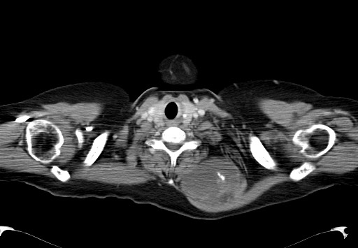 File:Chondrosarcoma - chest wall (Radiopaedia 65192-74199 C 2).jpg