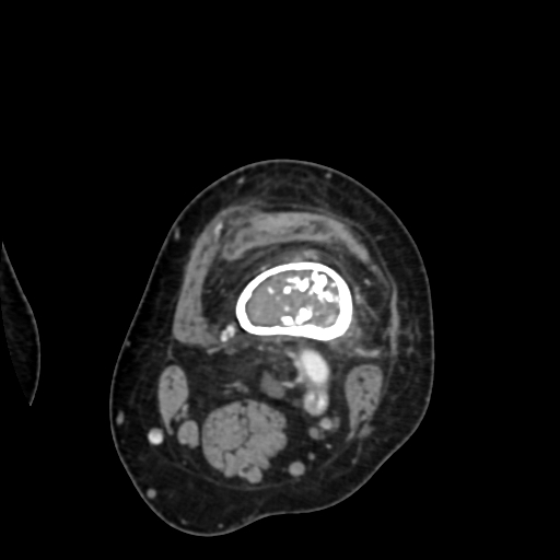 Chondrosarcoma - femur (Radiopaedia 64187-72954 Axial with contrast 26).jpg