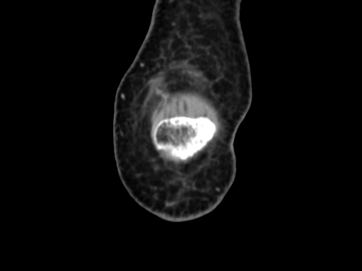 Chondrosarcoma - femur (Radiopaedia 64187-72954 C 4).jpg
