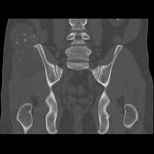 Chondrosarcoma of iliac wing (Radiopaedia 63861-72599 Coronal bone window 73).jpg
