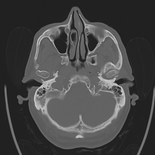 Chondrosarcoma of skull base- grade II (Radiopaedia 40948-43653 Axial bone window 6).png