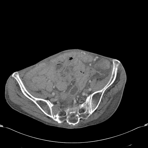Chondrosarcoma of the spine (Radiopaedia 49871-55143 A 49).jpg
