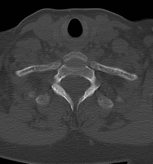 File:Chordoma (C4 vertebra) (Radiopaedia 47561-52188 Axial bone window 41).png