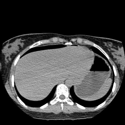 File:Choriocarcinoma of ovary with cerebral and pulmonary metastases (Radiopaedia 25983-26119 Axial non-contrast 38).jpg