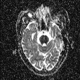 Choroid plexus xanthogranuloma - unilateral (Radiopaedia 85632-101393 Axial ADC 19).jpg