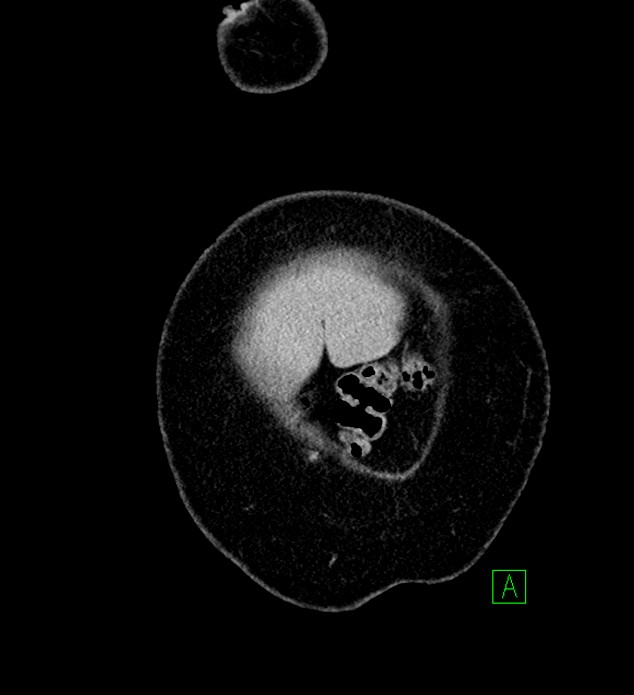 Chromophobe renal cell carcinoma (Radiopaedia 84239-99519 F 4).jpg