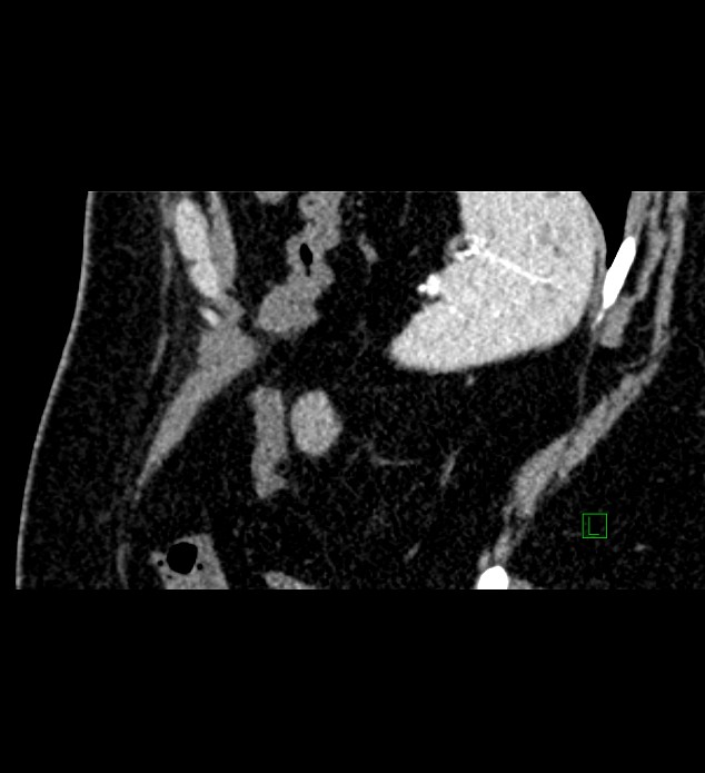 Chromophobe renal cell carcinoma (Radiopaedia 84286-99573 F 22).jpg