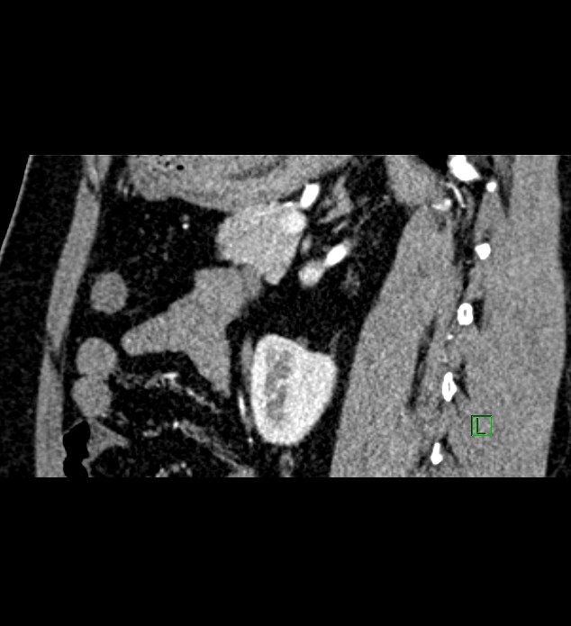 Chromophobe renal cell carcinoma (Radiopaedia 84286-99573 F 64).jpg