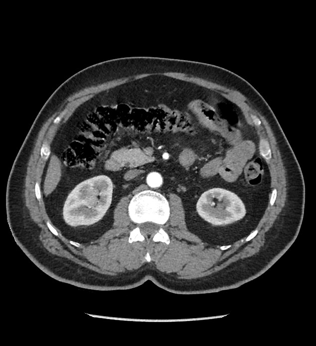 Chromophobe renal cell carcinoma (Radiopaedia 86879-103083 B 60).jpg