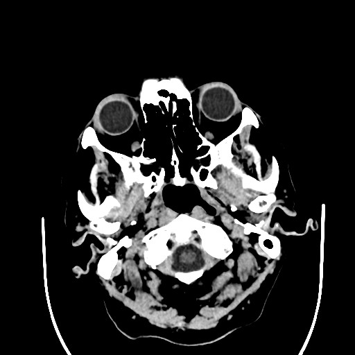 Chronic bilateral subdural hygroma (Radiopaedia 85801-101622 Axial non-contrast 24).jpg