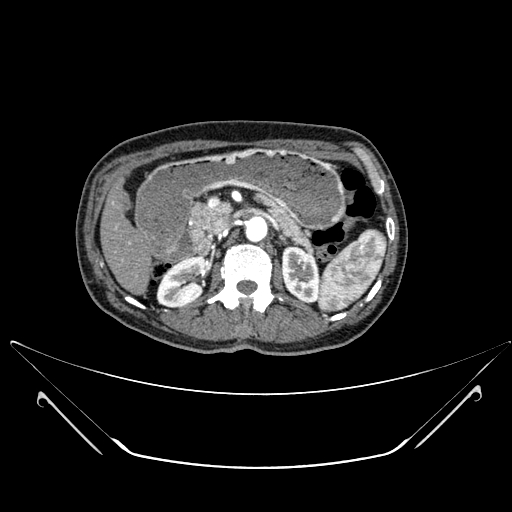File:Chronic contained rupture of abdominal aortic aneurysm with extensive erosion of the vertebral bodies (Radiopaedia 55450-61901 A 15).jpg