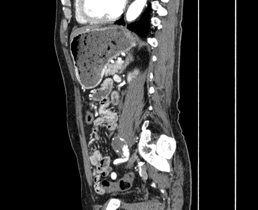 Chronic contained rupture of abdominal aortic aneurysm with extensive erosion of the vertebral bodies (Radiopaedia 55450-61901 B 50).jpg
