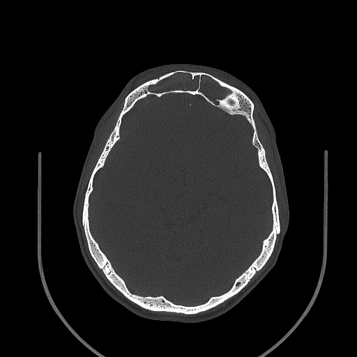 Chronic invasive fungal sinusitis (Radiopaedia 50342-55710 Axial bone window 116).jpg