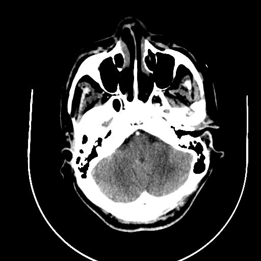 File:Chronic invasive fungal sinusitis (Radiopaedia 91563-109286 B 15).jpg