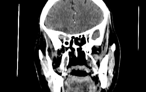 Chronic invasive fungal sinusitis (Radiopaedia 91563-109286 D 67).jpg