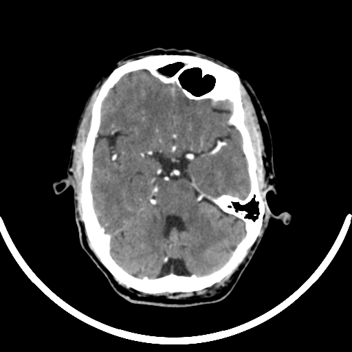 Chronic invasive fungal sinusitis with intraorbital and intracranial extension (Radiopaedia 56387-63046 B 133).jpg