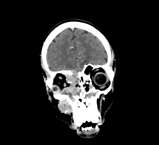 Chronic invasive fungal sinusitis with intraorbital and intracranial extension (Radiopaedia 56387-63046 C 87).jpg