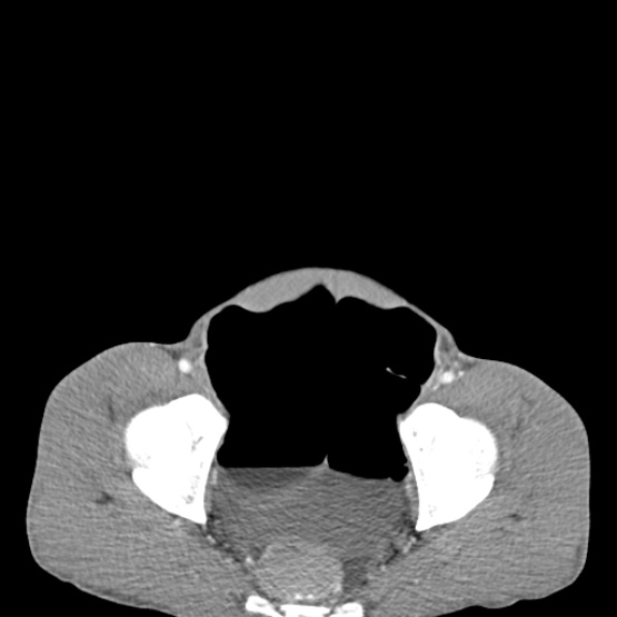 Chronic large bowel pseudo-obstruction (Radiopaedia 43181-46492 A 151).jpg
