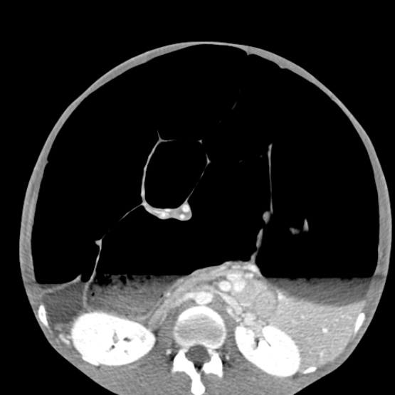 Chronic large bowel pseudo-obstruction (Radiopaedia 43181-46492 A 84).jpg