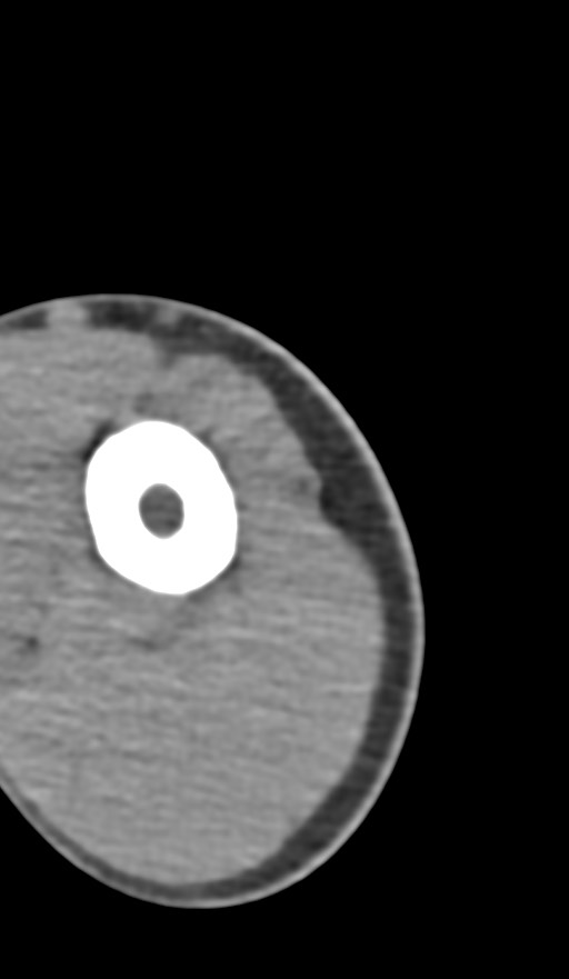 Chronic osteomyelitis of the distal humerus (Radiopaedia 78351-90971 Axial non-contrast 19).jpg